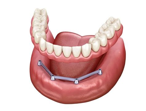 What to Know About removal of dental implants？