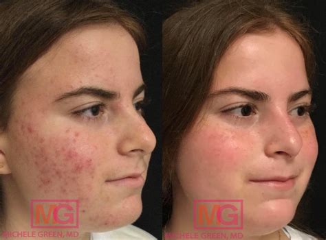 Is Accutane Safe? Top Accutane Questions Answered - Dr. Michele Green M.D.