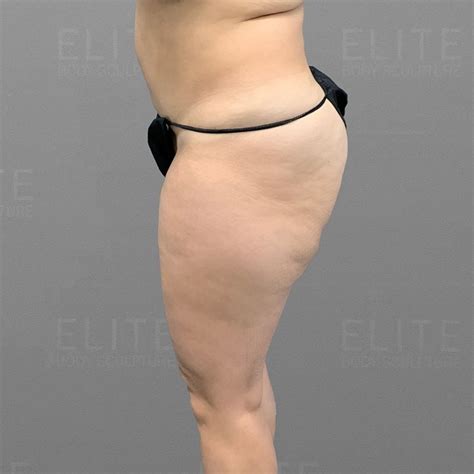 Banana Roll Liposuction in Miami | Banana Roll AirSculpt®