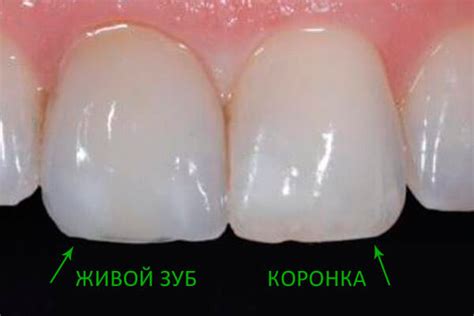 Металлокерамические коронки на передние зубы: что нужно знать