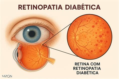 O Que É Retinopatia Diabética - Retinopatia diabética: Sintomas, causas e tratamentos