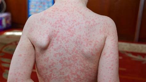Mono Virus: Know the Risks and Signs of a Severe Infection