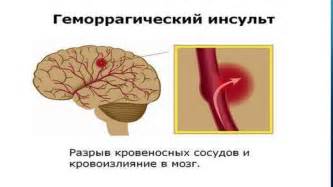 Геморрагиялық инсульт - презентация онлайн