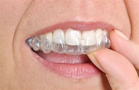 Removable Retainers | IQ Braces and Faces