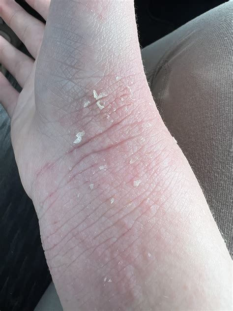 wrist eczema : r/eczema