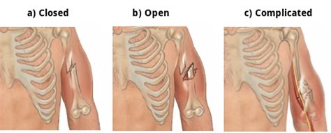 Open Vs Closed Fracture