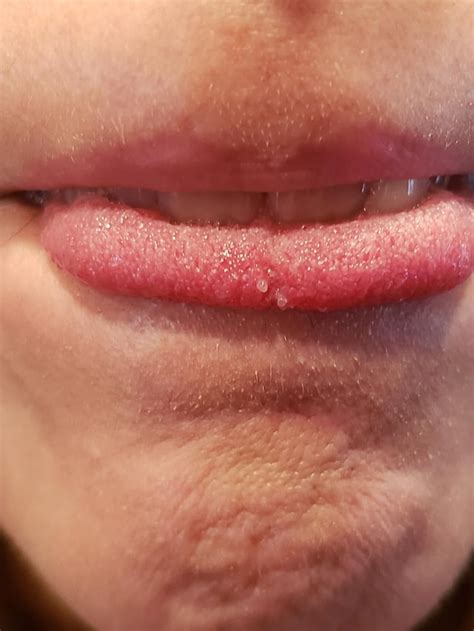 Bumps on Tongue? : r/medical