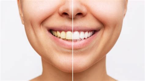 Limpeza Nos Dentes Antes E Depois - 7