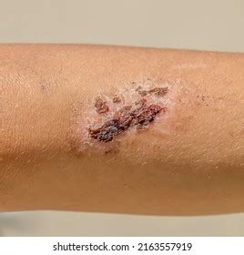 Healing Abrasion On Skin Closeup Stock Photo 2163557919 | Shutterstock