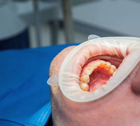 Photo of Dental fluorosis (also termed - ID:72630573 - Royalty Free ...