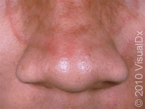 Ringworm Face