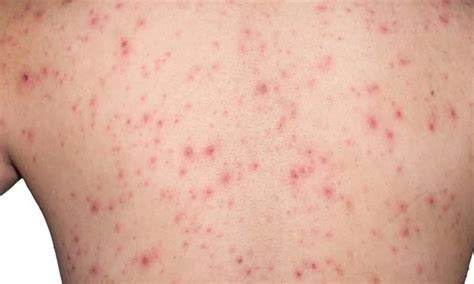 mengenal penyakit campak   pengobatannya parboaboa