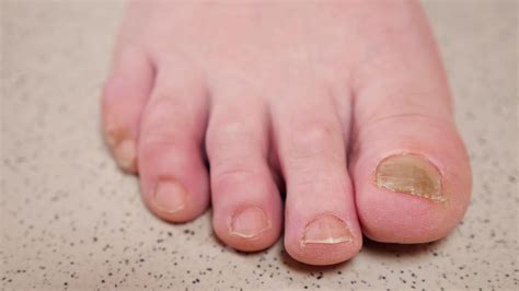 Types Of Toe Nail Diseases at Candice Cogar blog