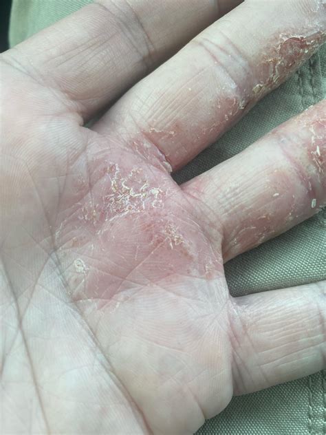 Painful rash on my hands : r/DermatologyQuestions