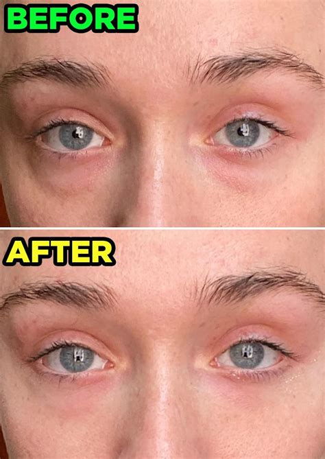 eye tightener  supposedly erases  eye bags  viral