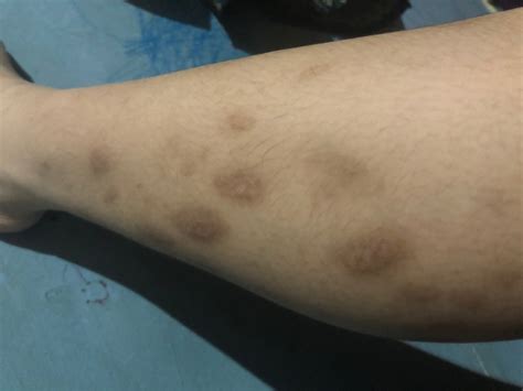 menghilangkan bekas luka hellosehat