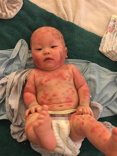 Toddler left screaming in agony with red raw, oozing skin after eczema