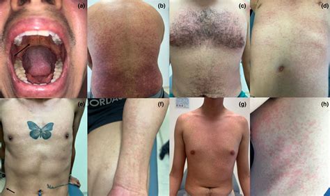 Eight patients with atypical Mpox. (a) patient with Forchheimer spots ...