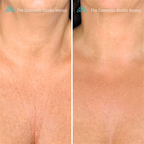 Chest Wrinkles Treatment | The Cosmetic Studio Noosa