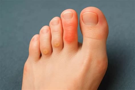 mallet toe treatment  london freedom clinics canary wharf