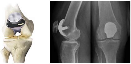 Patellofemoral Joint Replacement Sydney | Knee Surgery Darlinghurst, NSW