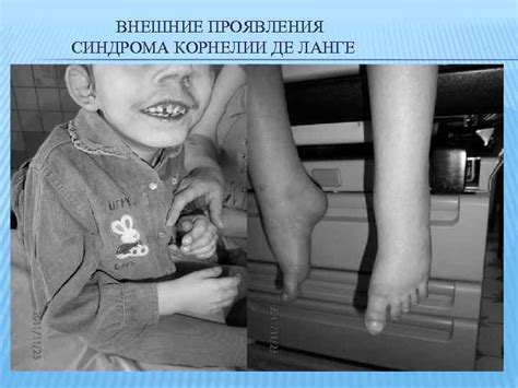 СИНДРОМ КОРНЕЛИИ ДЕ ЛАНГЕ Выполнила Иванова Екатерина Группа