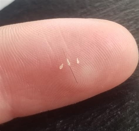 Does anyone know if these are lice eggs or not ? I appreciate the ...