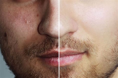 iPixel Laser Treatment of Acne Scars | VIPLaserClinicMedSpa