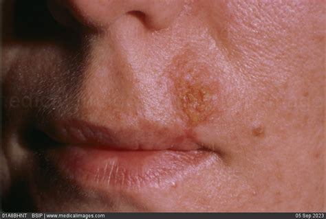 STOCK IMAGE, , 0038402, 01A8BHNT , BSIP - Search Medical & Scientific ...