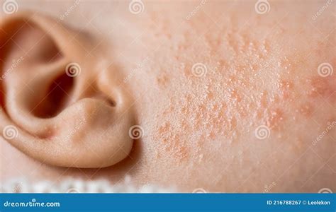 Rash or Red Pimples Allergic Skin on Baby Cheek Stock Image - Image of face, healthcare: 216788267