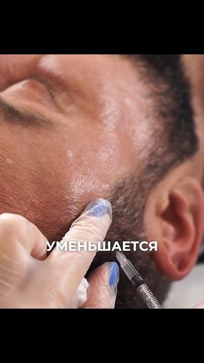 Как ботокс помогает при мигрени? - YouTube