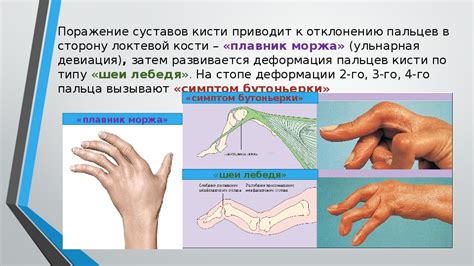 Сестринский уход при ревматоидном артрите
