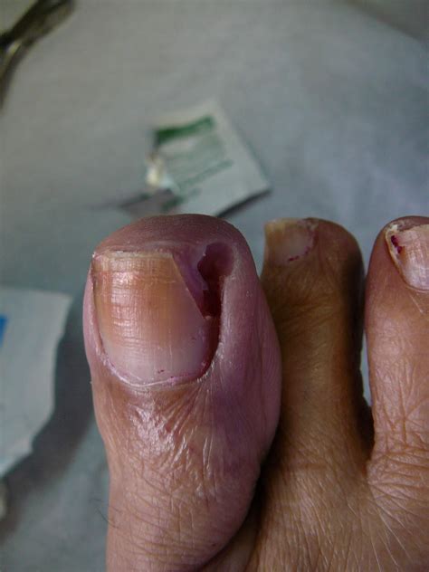 How Do Nails Grow Back After Falling Off - How long it would take to