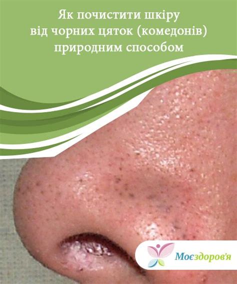 Get Rid of Blackheads Naturally