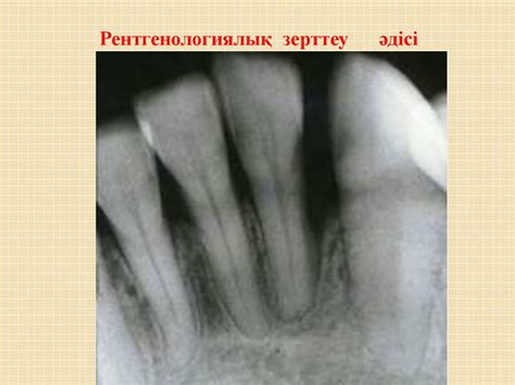 Пародонт аурулары. Түсінік, жүйесі, этиологиясы, патогенезі. Терминдер ...