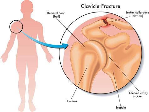 Clavicle Fractures | Shoulder Specialist Singapore