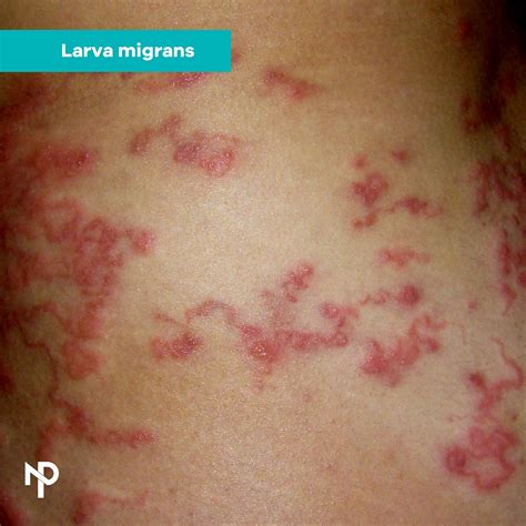 Larva migrans cutánea: una... - Dra. Natalia Peraza