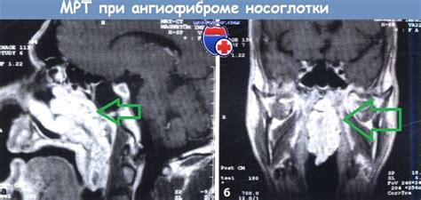 Рентгенография, КТ, МРТ глотки