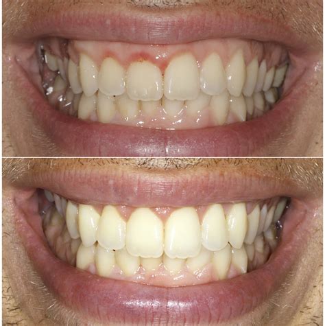 Soft Tissue Gum Graft | Before & After | Periodontist NYC