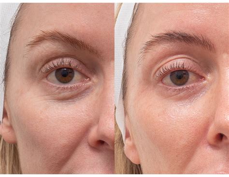 laser resurfacing   gallery  northside dermatology