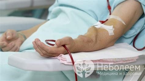 Артериовенозная фистула – симптомы, лечение, формы, стадии, диагностика