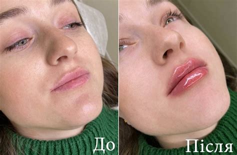 Увеличение губ Трускавец - цена угментации губ