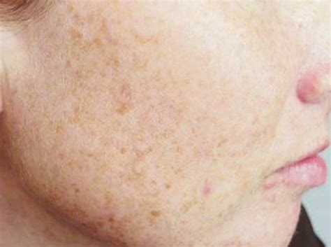types  skin pigmentation beautyandhealth