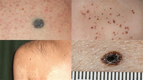 Skin Moles Types