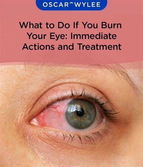 What to Do If You Burn Your Eye: Immediate Actions and Treatment