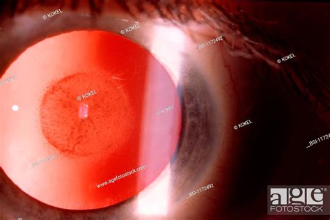 NUCLEAR CATARACT, Stock Photo, Picture And Rights Managed Image. Pic ...