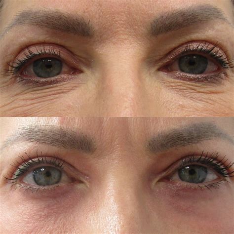 Does Laser Help Eye Bags at Richard Armes blog