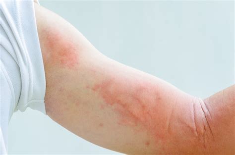 Как выглядит крапивница и ее отдельные формы? | MedAboutMe