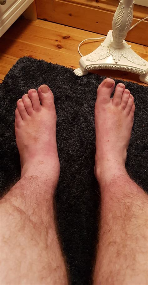 Does my left ankle look broken? Anti-inflammatory prescription isn't