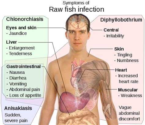 Opisthorchiasis history and symptoms - wikidoc